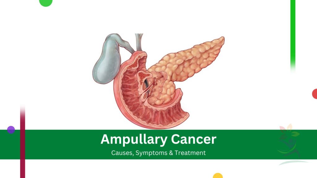 Ampullary Cancer