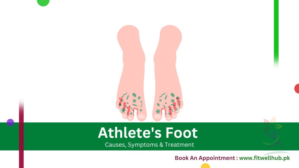 Athlete's Foot | Symptoms, Causes and Treatment Guide